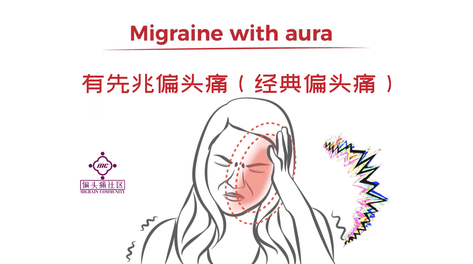 沉默型偏头痛